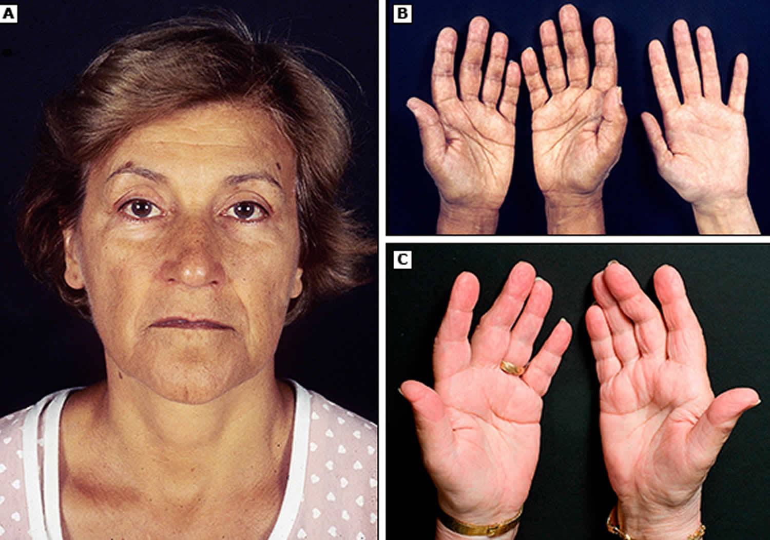 What Is Addison S Disease Symptoms Causes Diagnosis Treatment And